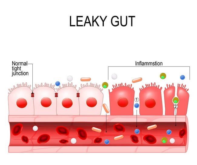  Was ist das "Leaky Gut"-Syndrom?
Das "Leaky Gut"-Syndrom, auch als "durchlässiger Darm" bekannt, ist ein Zustand, bei dem die Darmschleimhaut beschädigt ist. Normalerweise bilden die Zellen der Darmschleimhaut eine dichte Barriere, die nur Nährstoffe in den Blutkreislauf lässt. Bei einem Leaky Gut ist diese Barriere gestört. Die "Löcher" zwischen den Zellen (sogenannte Tight Junctions) werden größer, sodass unverdaute Nahrungsbestandteile, Bakterien und Toxine ungehindert in den Blutkreislauf gelangen können.